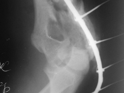 Переломы дистального конца плечевой кости