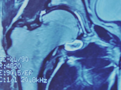 хондроматоз кульшового суглоба: діагностика, артроскопічне лікування, клініка Spinex