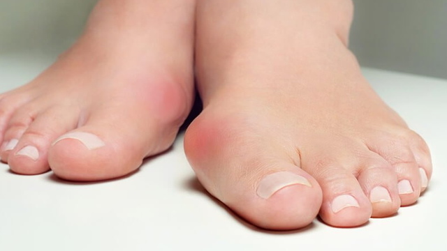 Халлюкс вальгус (hallux valgus) вальгусна деформація