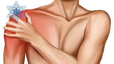 Синдром замороженого плеча