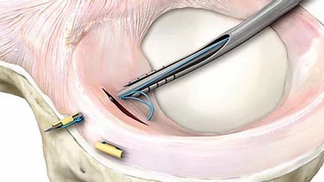 Артроскопічний шов меніска: «за» та «проти». Видаляти чи зшивати?