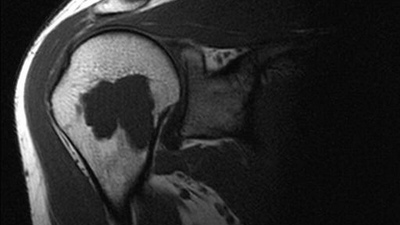 Асептический некроз головки плечевой кости