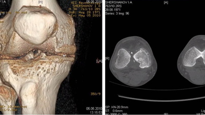 Особливості апаратної діагностики при захворюваннях колінних суглобів. КТ, МРТ, рентгенографія