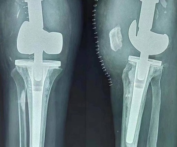 Случай из практики — реверсивный протез коленного сустава от Chunli Medical