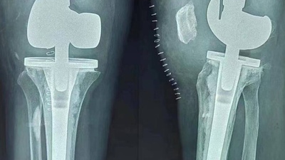 Случай из практики — реверсивный протез коленного сустава от Chunli Medical