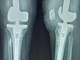 Випадок із практики - Реверсивний протез колінного суглоба від Chunli Medical