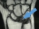 Болезнь Кинбека - остеонекроз полулунной кости, асептический некроз полулунной кости запястья, аваскулярный некроз, остеохондропатия полулунной кости