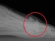 Hallux Rigidus - тугорухливість першого плюснефалангового суглоба великого пальця стопи, hallux limitus, деформуючий остеоартроз