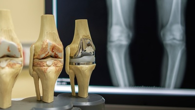 Гонартроз (остеоартроз коленного сустава). Когда ставить диагноз? Когда и как начинать лечить?