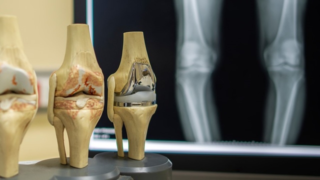 Остеоартроз (остеоартрит) колінного суглоба. Коли ставити діагноз? Коли та як починати лікувати?