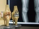 Остеоартроз (остеоартрит) колінного суглоба. Коли ставити діагноз? Коли та як починати лікувати?