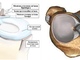 Дискоидный мениск – врожденная аномалия строения менисков коленного сустава