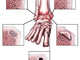 Остеохондрит таранної кістки (остеохондральні пошкодження таранної кістки)