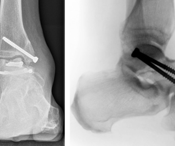 Переломи таранної кістки: сучасні аспекти діагностики та лікування