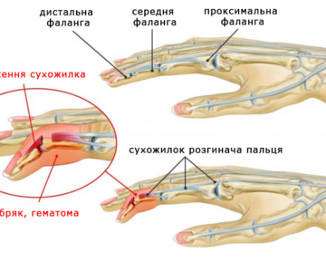 Пошкодження сухожилків розгиначів пальців кисті на рівні дистальної фаланги