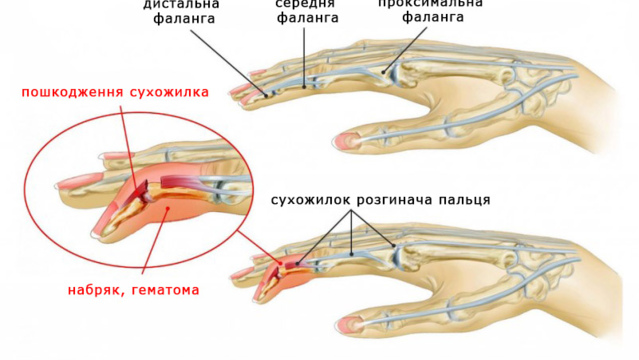Пошкодження сухожилків розгиначів пальців кисті на рівні дистальної фаланги