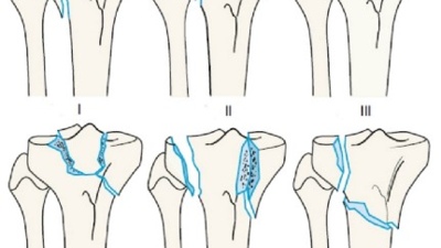 Переломи проксимального відділу гомілки. Сучасний підхід у діагностиці та лікуванні