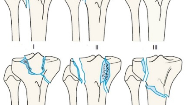 Переломи проксимального відділу гомілки. Сучасний підхід у діагностиці та лікуванні