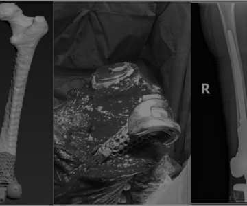 Issues of Knee Joint Endoprosthetics in Megadefects Cases: Opportunities and Challenges