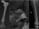 Issues of Knee Joint Endoprosthetics in Megadefects Cases: Opportunities and Challenges