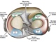 Частина 3. Травматичні ушкодження та захворювання менісків