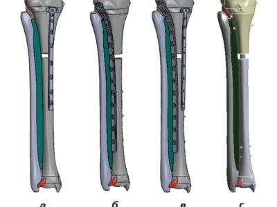 Твердотільні моделі кісток гомілки  з варіантами фіксації кісткових відламків із за- стосуванням пластин LCP унілатерально по ме- діальній поверхні великогомілкової кістки (а),  унілатерально по латеральній поверхні велико- гомілкової кістки (б), білатерально (в) та інтра- медулярного блокуючого остеосинтезу метале- вим стрижнем (г)