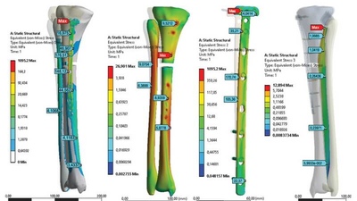 Биомеханический анализ надежности фиксации костных отломков переломов проксимального отдела большеберцовой кости