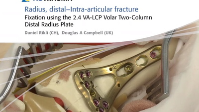 Фиксация внутрисуставного перелома двойной дистальной лучевой ладонной пластиной с винтами с угловой стабильностью и переменным углом