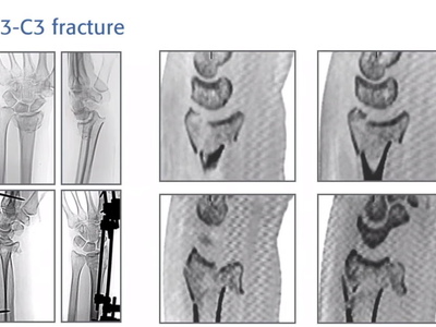 Лучевая кость, дистальный отдел - Фиксация внутрисуставного перелома двойной дистальной лучевой ладонной пластиной с винтами с угловой стабильностью и переменным углом (AO TRAUMA)