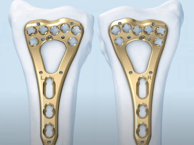 Лучевая кость, дистальный отдел - Фиксация внутрисуставного перелома двойной дистальной лучевой ладонной пластиной с винтами с угловой стабильностью и переменным углом (AO TRAUMA)