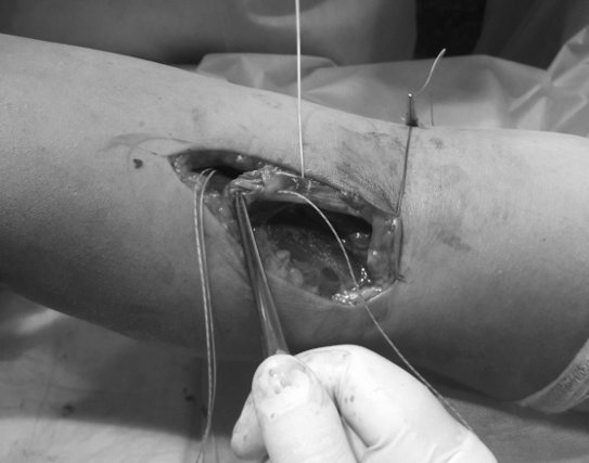 Виділення частини пошкодженого сухожилка та введення анкера у горбистість променевої кістки