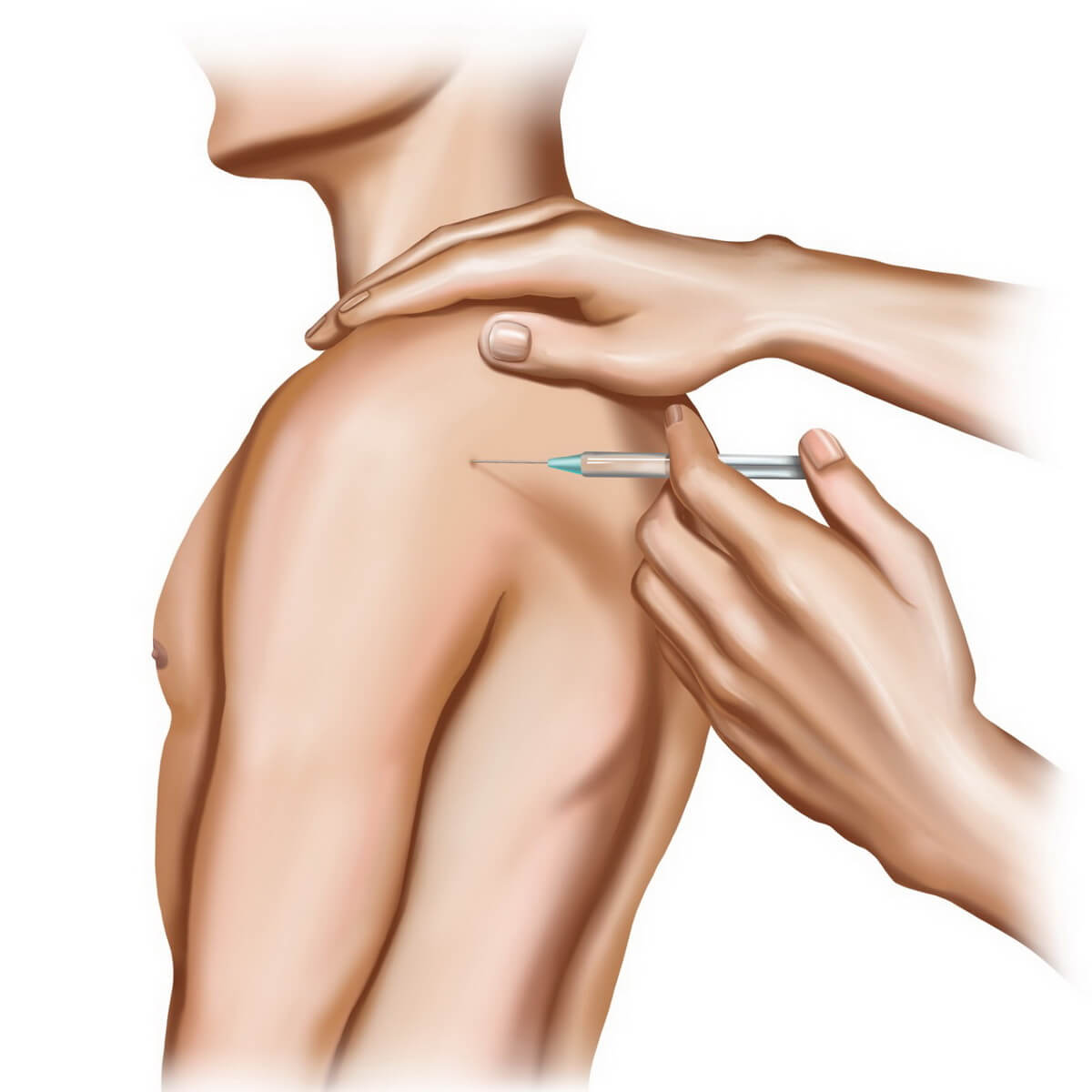 Лікування «замороженого плеча» завжди комплексне та залежить безпосередньо від стадії захворювання.