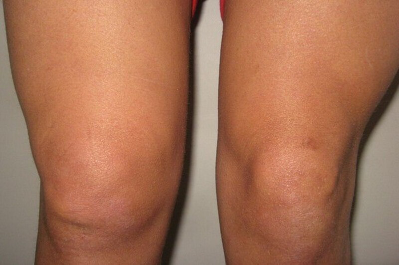 Степени и симптомы гемартроза коленного сустава