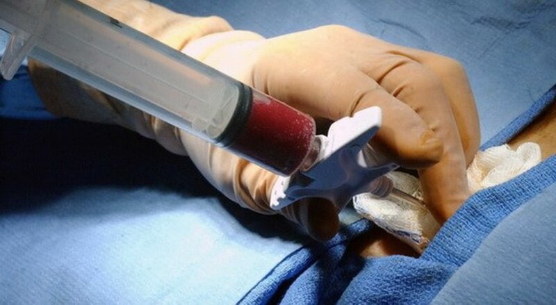 При гемартрозе второй и третьей степени выполняется пункция сустава – удаление при помощи иглы и шприца крови из его полости. 