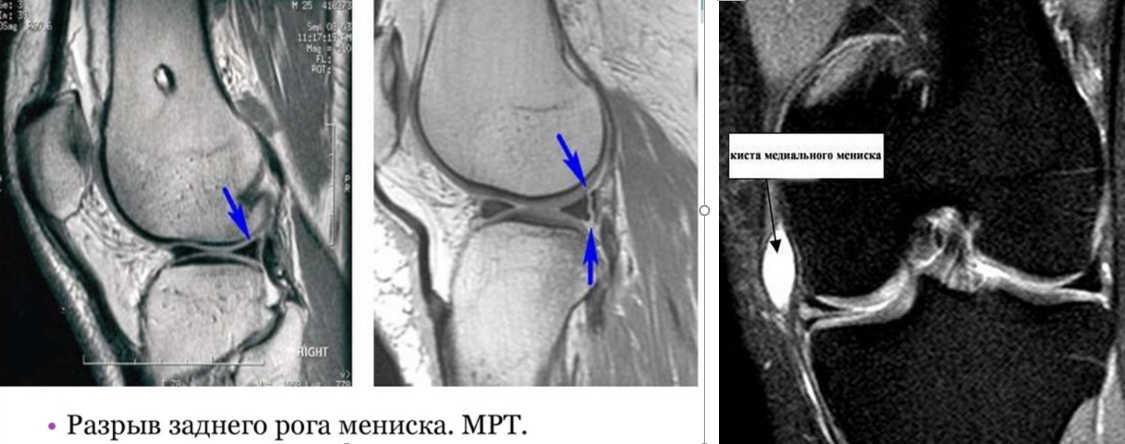 Діагностика пошкоджень менісків колінного суглоба