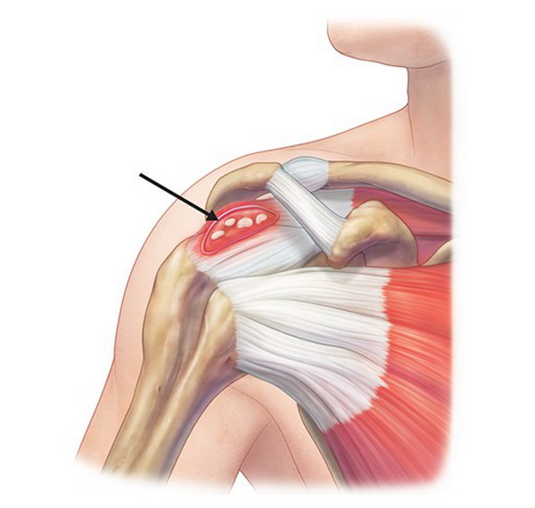 Разрыв плечевого сустава симптомы. Ротаторная манжета плечевого сустава. Ротаторная манжета плеча тендинит. Кальцифицирующий тендинит. Ротаторная манжета плечевого сустава разрыв.