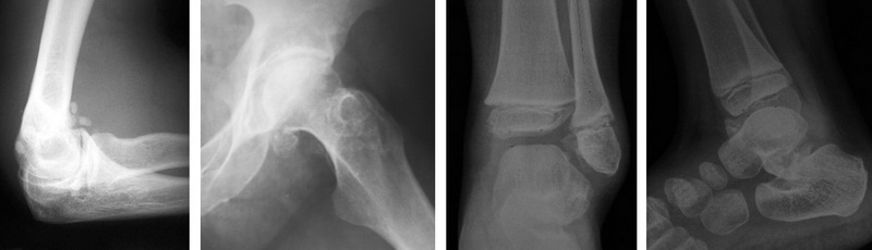 Хондроматоз колінного суглоба - хронічний патологічний процес, при якому синовіальна оболонка суглоба частково зазнає змін, поступово перетворюючись на хрящ.