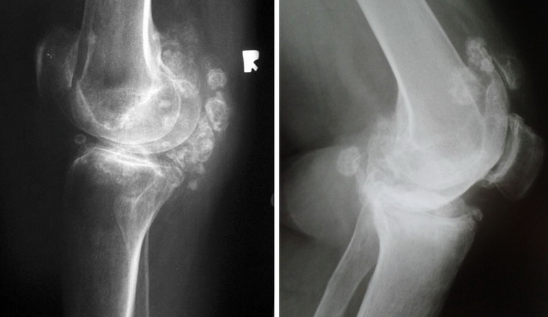 Хондроматоз колінного суглоба - хронічний патологічний процес, при якому синовіальна оболонка суглоба частково зазнає змін, поступово перетворюючись на хрящ.