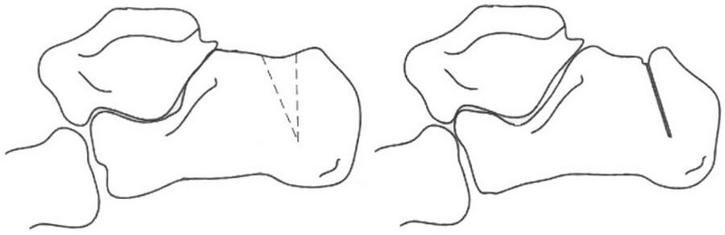 Деформація Хаглунда (синдром Хаглунда, синдром болю задньої області п’яти, остеофіт задньої частини п'яткової кістки)