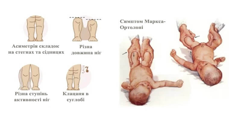 Ознаки дисплазії кульшових суглобів у новонароджених