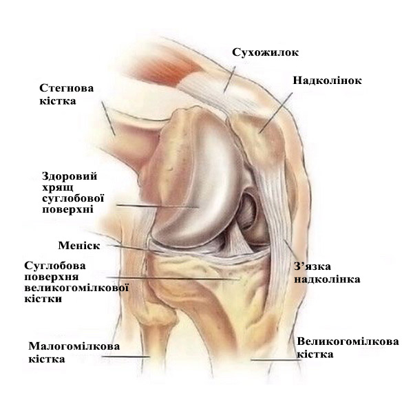 Гонартроз - деформівний (деформуючий) артроз колінного суглоба