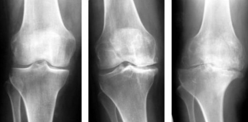 Синдром офісного коліна – це остеоартрит (ОА) колінного суглоба – гонартроз.