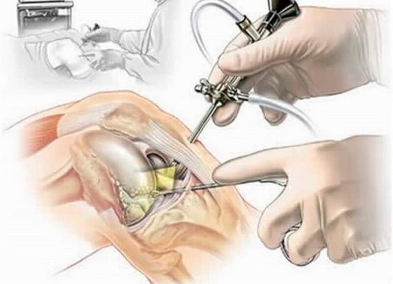 Артроскопія колінного суглоба  - мінімально інвазивна хірургічна маніпуляція для діагностики та/або лікування пошкоджень внутрішньої часини суглоба (зв’язок, менісків, синовіальної оболонки)