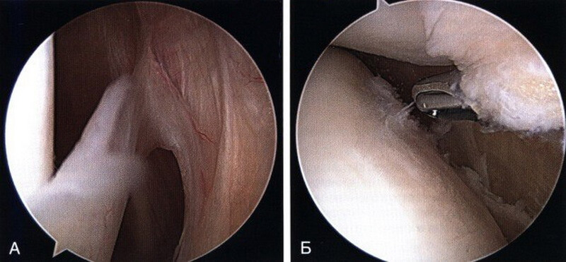 Медіопателлярна синовіальна складка в передньому відділі колінного суглоба