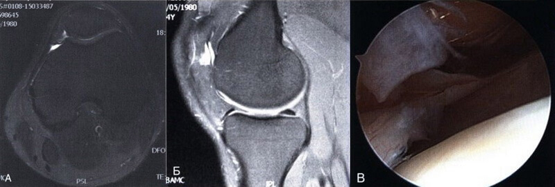 Аксіальна (А) і сагітальна (Б) МР-томограми в режимі Т2 з ознаками локалізованого скупчення рідини в порожнині суглоба внаслідок наявності патологічної синовіальної складки. (В) Артроскопічна картина у цього ж пацієнта.