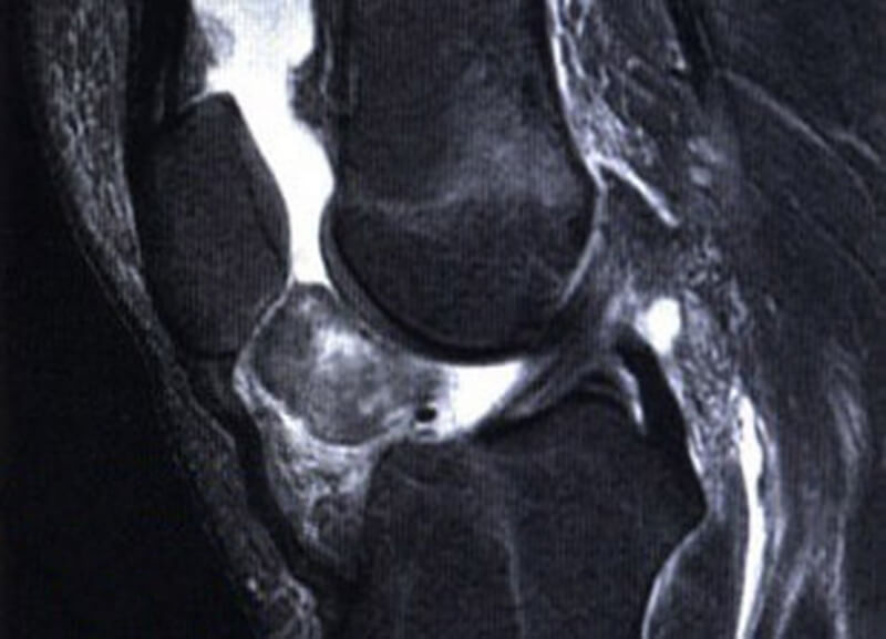 Сагиттальная МР-томограмма коленного сустава в режиме Т2 пациента с ограниченным пигментным ворсинчато-узелковым синовитом. 