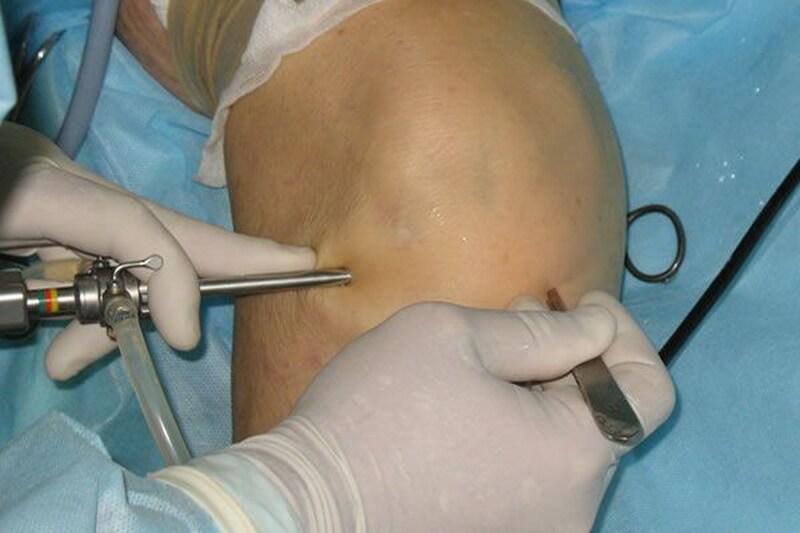 Артроскопічна сіновектомія колінного суглоба