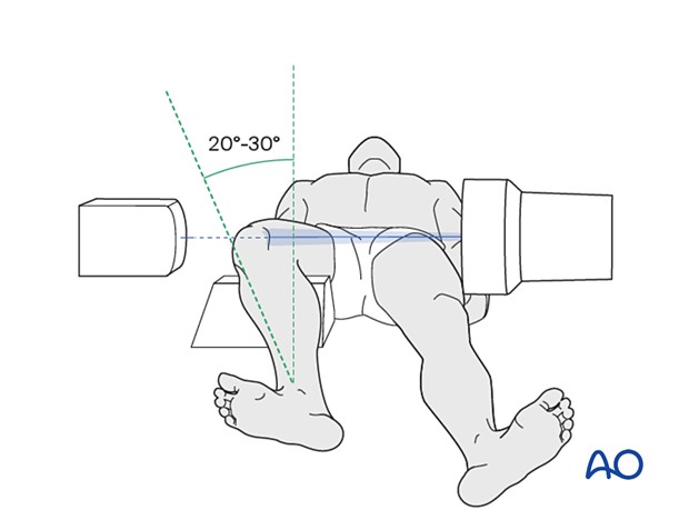 Інтраопераційна візуалізація наколінка (наколі́нок, надколінок, надколінник (лат. patella, колінна чашечка)