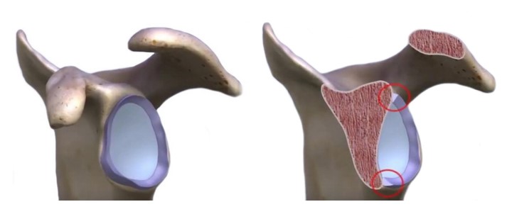 Пошкодження суглобової губи плечового суглоба – SLAP (Superior Labrum Anterior to Posterior)