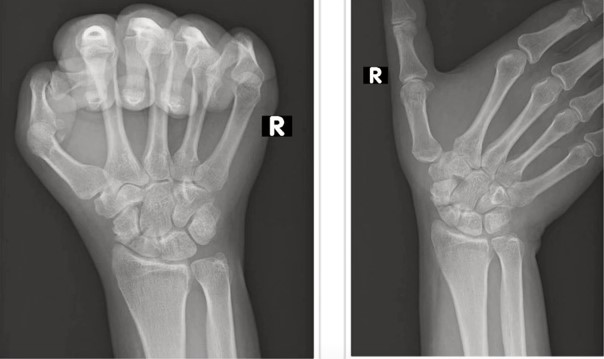 Особливі проекції в рентгенодіагностиці перелому човноподібної кістки: долоня стиснута в кулак (ліворуч) та Ziter-проекція з девіацією кістового суглоба (праворуч)